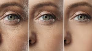 Under Eye RF Microneedling